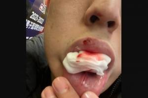 宋翔社媒晒沈梓捷伤情：嘴部几处被打破 咬着纱布打完全场