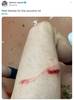 慎入！拉波尔特赛后晒大腿伤口：谢谢你送的纪念品，哈哈