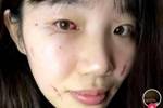 北京女篮中锋刘晶赛后眼部结膜出血 鼻骨骨折 并且面部有多处抓伤